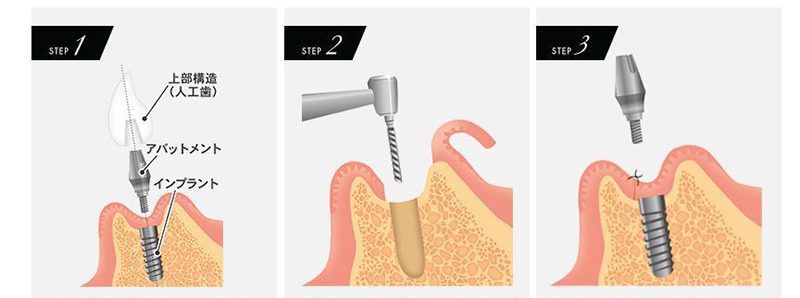 インプラント治療のながれ｜郡山ファースト歯科矯正歯科
